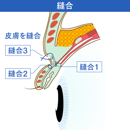 眼瞼下垂の皮膚を縫合するイメージ