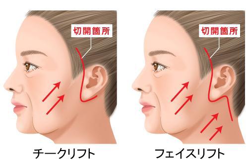 フェイスリフト フルフェイスリフト 公式 オザキクリニック 美容整形 美容外科 美容皮膚科 東京新宿 目黒祐天寺 羽村 フェイスリフト フルフェイスリフト 公式 オザキクリニック 美容整形 美容外科 美容皮膚科 東京新宿 目黒祐天寺 羽村