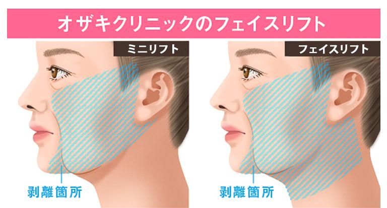 フェイスリフト フルフェイスリフト 公式 オザキクリニック フェイスリフト フルフェイスリフト 公式 オザキクリニック