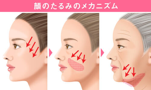 顔のたるみのメカニズム
