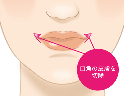 口角挙上（スマイルリップ）の口角の皮膚を切除するイメージ