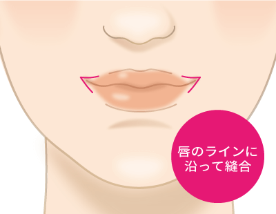 口角挙上（スマイルリップ）の縫合して唇の形を整えるイメージ