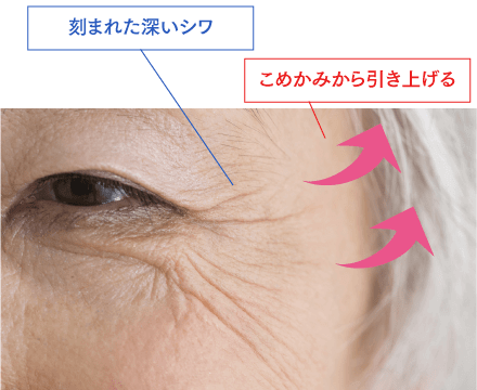 目尻のシワのイメージ