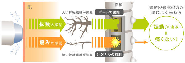 サーマクール治療イメージ