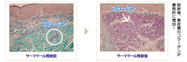 サーマクール照射後、真皮層のコラーゲンが爆発的に増加!