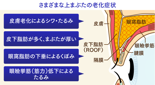 さまざまな上まぶたの老化症状