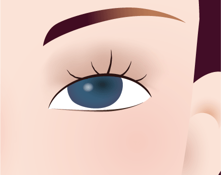 上まぶたのたるみ取りのイメージ
