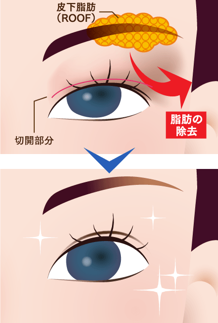 上まぶたのたるみ取りのイメージ