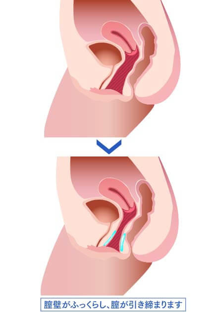 膣壁がふっくらし、膣が引き締まるイメージ