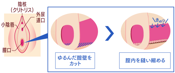 膣縮小術（切開法）施術イメージ