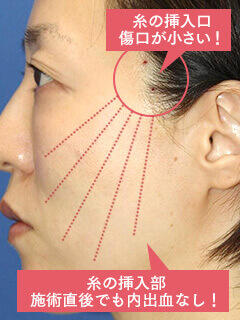 VOVリフトプレミアムの挿入イメージ