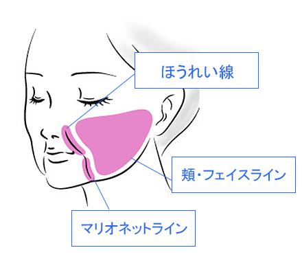 VOVリフトプレミアムの適応症状のイメージ