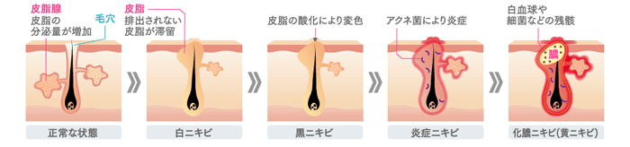 正常な毛穴の状態から、排出されない皮脂が滞留しはじめると、白ニキビとなります。そこからやがて皮脂が空気に触れ、酸化により変色すると黒ニキビとなります。さらにアクネ菌の増殖により炎症することで炎症ニキビとなり、悪化すると白血球や細菌などの残骸が膿となり、化膿ニキビ（黄ニキビ）と変化します。