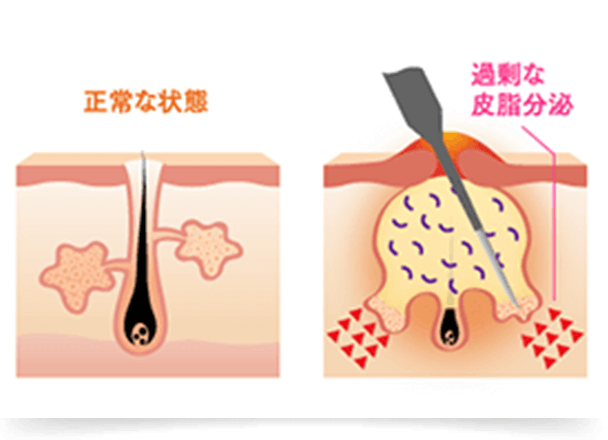 やっかいな大人ニキビを根本から解決するには、電気治療『小林式ニキビ治療法』が大変効果的です。皮脂腺を絶縁針で凝固させて異常な皮脂腺のみ壊すことで、大人ニキビの再発を断ち切ることができます。