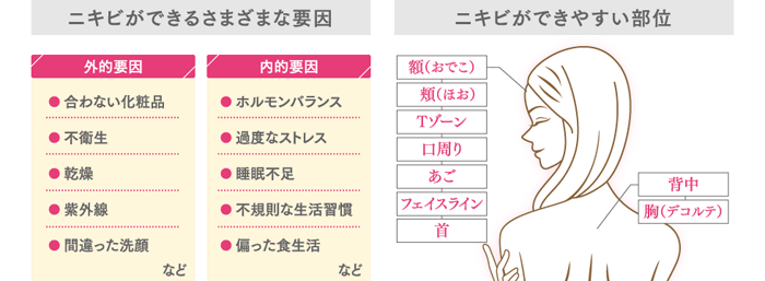 ニキビができやすい部位は、額（おでこ）、頬（ほお）、Tゾーン、口周り、あご、フェイスライン、首、背中、胸（デコルテ）などです。