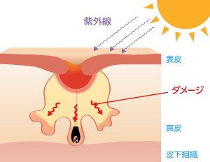 炎症した赤ニキビが悪化したり、紫外線や指でつぶすなどの強い刺激によってダメージが深層まで及ぶと、炎症後の色素沈着や赤みが肌深層に残ってしまったり、コラーゲンの変性や異常増殖によって皮膚がクレーターのような凸凹した状態となります。これがニキビ跡です。