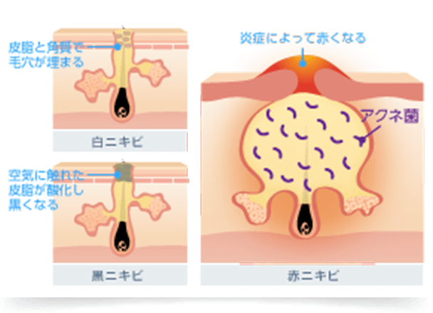 皮脂と角質が毛包内に埋もれ毛穴が塞がった状態の白ニキビや、毛穴が開き皮脂が酸化した状態の黒ニキビができます。毛穴に詰まった皮脂に細菌が繁殖すると炎症が起き、赤く腫れ熱を帯びた赤ニキビへと悪化します。