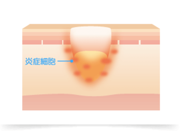 炎症がさらに悪化し、炎症が周囲の組織に波及すると、破壊された部分にはたくさんの炎症細胞が集まってきます。真皮内に瘢痕が作られ拘縮を起こし、この瘢痕の広がりによっていわゆる「クレーター・アクネスカー」と言われる皮膚の凹凸ができます。