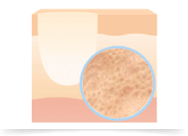 ニキビ炎症後に凹凸ができてしまった状態。クレーター状のニキビ跡は炎症により組織が破壊されたり、コラーゲンの変性により毛穴の形状を維持できなくなることで起こります。毛穴周辺が盛り上がる場合もあります。