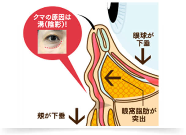 加齢などによって眼球を支える靭帯が弱くなると、眼球が下がってきます。すると、眼球の周りにある眼窩脂肪が押し出され、手前に飛び出してきます。また同時に、頬の脂肪は下垂してボリュームを失います。この2つの加齢症状が同時に起こることで、目の下と頬との境界に凹凸（溝）ができ、凹凸によってできる陰影がクマとなりますので、「溝」の部分のボリュームを補う治療が効果的です。