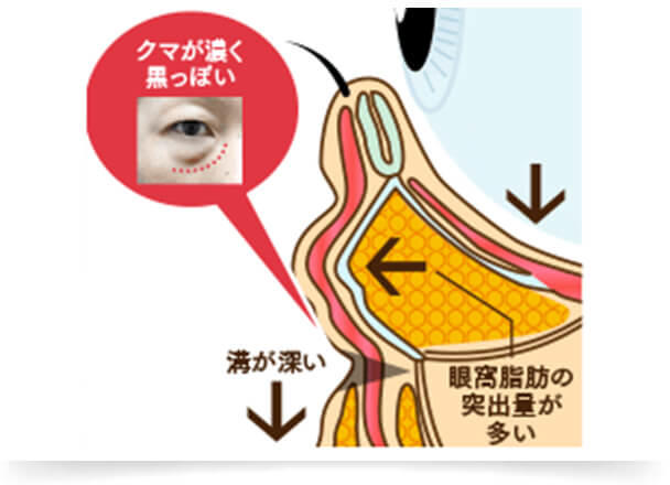 症状が進行すると、飛び出す眼窩脂肪の量が増えて、凹凸がより深くなってきます。目の下の膨らみが分かるようになり、さらに頬のボリュームもどんどん減少していくので、目の下だけでなく、ゴルゴラインも目立つようになります。目の下の膨らみの原因である突出した眼窩脂肪は除去し、ボリュームが減少してくぼんでいる部分にはボリュームを補う治療が必要となります。