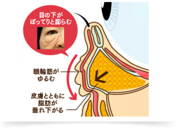 さらにたるみ症状が進行すると、眼窩脂肪を支えている眼輪筋がゆるみ、皮膚を押し出すように脂肪が飛び出してきます。この時、眼輪筋とともに皮膚も伸びて、たるんでいる状態です。そのため、脂肪、眼輪筋、皮膚の3つにアプローチする治療が必要となります。