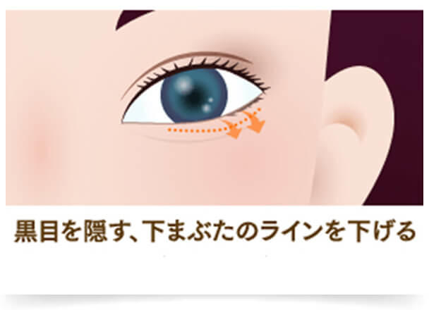 つり目や小さい目を気にしている方におすすめの治療法『タレ目・でか目整形』は、大きな「タレ目」になることができます。目が大きくなるだけでなく、顔全体の印象がふんわり優しくなり女性らしさがアップします。形成術で手頃な『ヒアルロン酸涙袋』も目の下の涙袋を形成することで大きくかわいらしい目元へ導きます