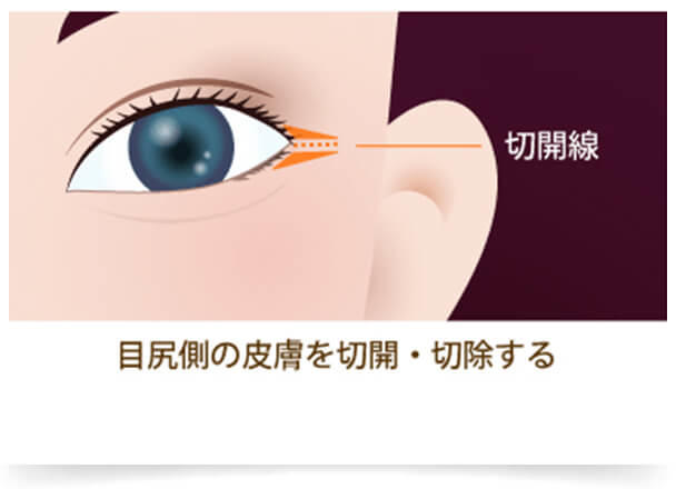 「目頭切開」は目の内側は切開し、「目尻切開」は目の外側を切開することで、目力がアップ。どちらも「目」を大きくするだけでなく、顔全体のバランスを整えることもできるので、小顔効果も期待できます。