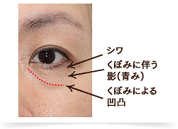 加齢とともに頬の脂肪は下へ下へと下垂します。それに伴い目の下の脂肪はボリュームを失うため、目の下にくぼみができます。この目の下のくぼみと頬との境界に凹凸ができ、凹凸による陰影によって目元の印象も暗くなります。