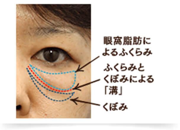 眼球と頬の脂肪の下垂が同時に進行し、「ふくらみ」と「くぼみ」が混在しているタイプです。混合タイプは「ふくらみ」と「くぼみ」のどちらか片方のみを解消しても目の下の凹凸は開所されず、場合によっては目の下のクマが濃くなってしまうこともあります。そのため、目の下のたるみ状態を的確に見極め、「ふくらみ」と「くぼみ」を同時に解消することが重要となります。