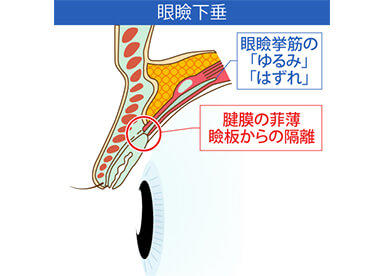 上まぶたを引き上げる筋肉「眼瞼挙筋」を「瞼板（けんばん）」に固定することで、挙筋の引き上げまぶたの開きを良くさせる治療法です。