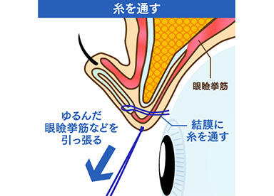 細い糸をつかってゆるんだ筋肉を縫い縮めることで、上まぶたを開く力を強くする治療法です。