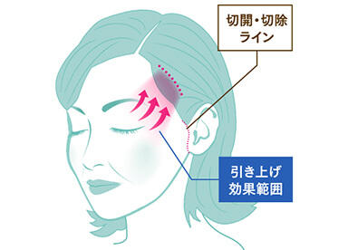 側頭部を切開して、たるんだ皮膚を除去し、上まぶたのたるみを解消する治療法です。