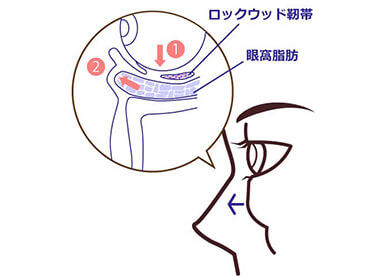 目の下の脱脂イメージ