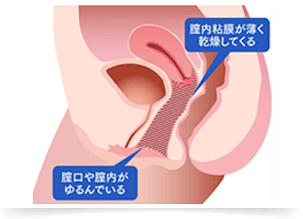 膣口や膣内は、産後のダメージや膣の老化・ホルモン低下によりゆるみ、膣内粘膜が薄くなり乾燥してきます。