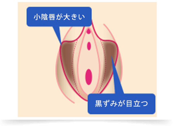 小陰唇がもともと大きく、痛みや見た目で悩んでいる方は多くいらっしゃいます。 擦れて痛みを伴う、黒ずみが目立つなどの小陰唇のお悩みなら、形をきれいに整える『小陰唇縮小術』がおすすめです。切らずに小陰唇の付け根を引き締めたり、黒ずみを除去するレーザー治療も行っています。