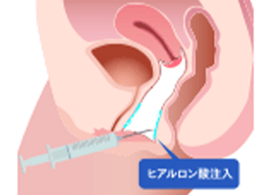 膣の乾燥が気になる場合は、潤い成分のヒアルロン酸や自身の脂肪を膣内粘膜へ注入することで、簡単に膣内をふっくらと肉厚で潤いに満ちた環境へ改善することが可能です。