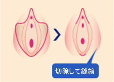 切開を最小限に抑えて余剰部分を切除し、美容観点から小陰唇の形状を小さく美しく仕上げます。1回の治療で高い治療効果が得られます。