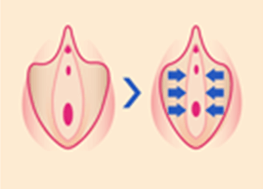 小陰唇周辺にレーザーを照射することで、ゆるんでいた小陰唇を強力に引き締めます。膣口や尿道口付近のゆるみも合わせて改善します。