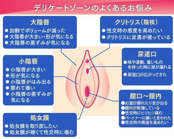 デリケートゾーンのよくあるお悩みとしては、加齢により大陰唇のボリュームが減った、小陰唇の形や黒ずみが気になる、擦れて痛い、クリトリス（陰核）の被っている皮膚を切除したい、処女膜を再生させたい、尿漏れが気になる、などがあります。