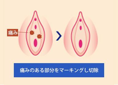 『膣前庭部切除術』では、痛みに過敏になっている部分を切除することで、性交痛の原因でもある膣前庭部痛を改善します。