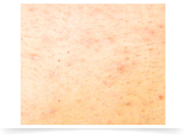 毛孔性苔癬はニキビ特有のかゆみや痛みなどはほとんどなく、左右対称にできる点です。そのため、痛みを伴う赤いぶつぶつが片腕や片脚などにまばらに点在しているようであれば、それは「ニキビ」の可能性が高いといえます。また、ムダ毛処理で肌へ過度な刺激を与え、「色素沈着」など肌の黒ずみをつくっている場合があります。 これらの症状は、それぞれ適した治療法により解決ができます。