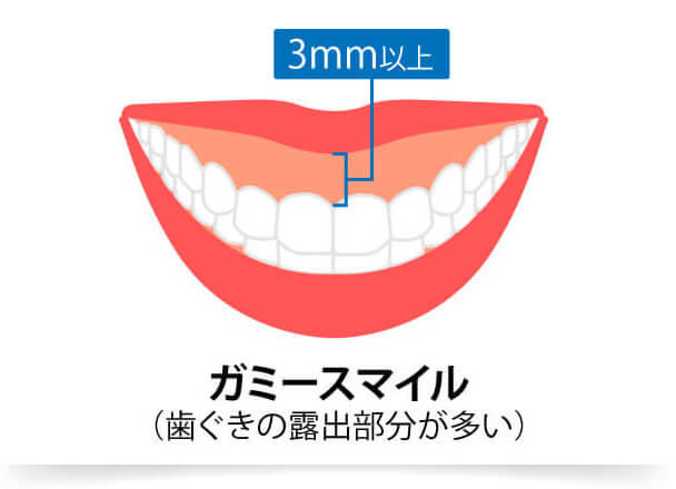 笑った時に歯茎が3mm 以上見えている状態を「ガミースマイル」といい、ガミースマイルを改善することで、思いっきり笑っても歯茎の露出を気にせずお過ごしいただけます