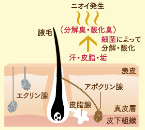 ワキガとは、独特な強いにおいを放つ体質や症状のことを指し、腋臭症とも呼ばれています。 人の身体には、「アポクリン腺」と「エクリン腺」と呼ばれる2種類の汗腺が存在します。ワキガは、2つのうち「アポクリン腺」から分泌された汗が要因となります。「アポクリン腺」は、脂質や糖質、アンモニアや鉄分などにおいの原因物質を多く含み、乳白色で粘り気があるのが特徴です。耳の中やワキの下などに多く存在します。汗自体はほとんどにおいはしませんが、細菌によって汗に含まれる物質が分解されることで強烈なにおいを発生させます。ワキガでお悩みの方は、この「アポクリン腺」の量が多く、汗腺自体が大きい傾向にあります。