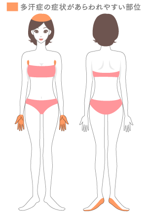 多汗症とは、特に体温調節がいらない時期でも大量の汗をかく症状のことです。 人間が出す汗のほとんどは「エクリン腺」と呼ばれる汗腺から分泌されています。成分のほとんどが水分と塩分で構成されており、無色でにおいや粘り気はありません。全身に存在していますが、特に額や手のひら、足の裏などに「エクリン腺」が多い傾向にあります。 本来であれば、「エクリン腺」は体温調整や皮膚の乾燥を防ぐなどの役割を担っていますが、この汗腺が緊張などの精神的なストレスや、ホルモンバランスの崩れなど生活習慣の影響によって分泌が活発になることで、汗を大量にかくようになります。