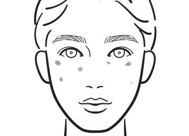 日光性色素斑（老人性色素斑）・脂漏性角化症イメージ