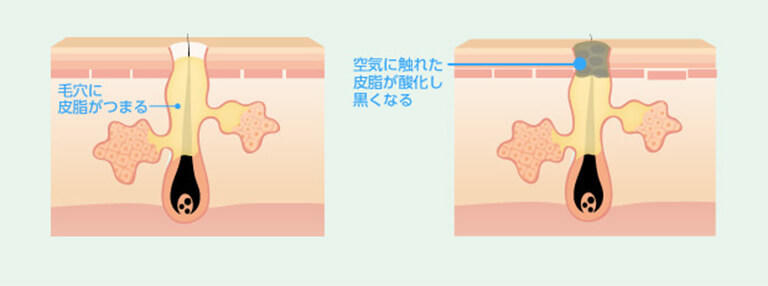 毛穴の黒ずみの主な原因は、毛穴に詰まる「角栓」です。この角栓が肌表面に出没し、さまざまな刺激により酸化してしまうことで、毛穴の黒ずみが生まれます。