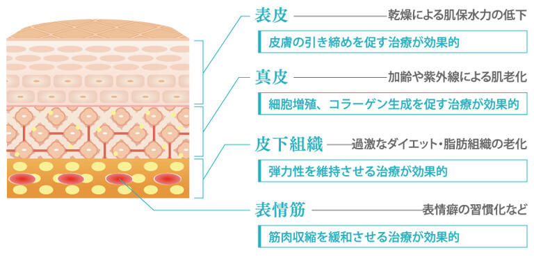 「表皮」のシワは乾燥による肌保水力の低下が原因のため、皮膚の引き締めを促す治療が効果的、「真皮」のシワは加齢や紫外線による肌老化が原因のため、細胞増殖、コラーゲン生成を促す治療が効果的、「皮下組織」のシワは過激なダイエット・脂肪組織の老化が原因のため、弾力性を維持させる治療が効果的、「表情筋」のシワは表情癖の習慣化など、筋肉収縮を緩和させる治療が効果的です。