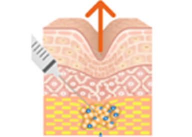 肌再生高純度脂肪注入は、採取した自身の脂肪細胞を、顔のくぼみ部分に注入することで、滑らかな肌へ改善する治療です。細胞同士が生着をするため、ヒアルロン酸注射のように体内に吸収されることがなく、治療効果を長期間キープできます。