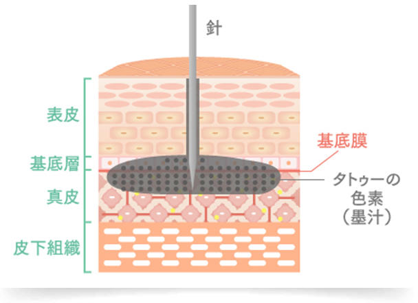 刺青・タトゥーは、針や刃物を用いて点状の傷を作り、真皮層に色素を沈着させる技法です。 皮膚は表皮と真皮、皮下組織の3つの層で構成されており、皮膚のターンオーバーは表皮の中でも最下部にある「基底層」で、新しい表皮細胞を生成しています。 しかし、表皮よりも深い真皮層に沈着している色素は、新陳代謝とともに表層に押し上げられることがないため、排出されずに肌に色素が残り続けます。また、沈着しやすい成分を使用していることも理由のひとつとして考えられます。 そのため、刺青・タトゥーを除去するには、真皮層への治療が必要となりますが、皮下組織の脂肪層にまで色素が沈着しているケースも多々あり、深層になればなるほど場合によっては治療が難しくなっていきます。